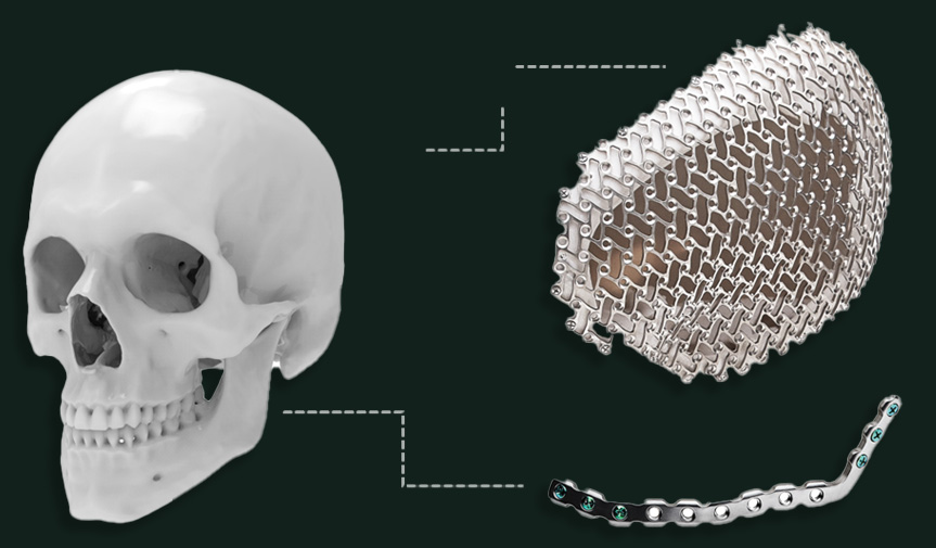 Patient-Specific Implants